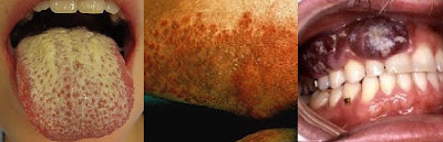 El ácido salicílico para la psoriasis
